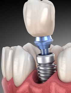 -20% en Implantes de titanio