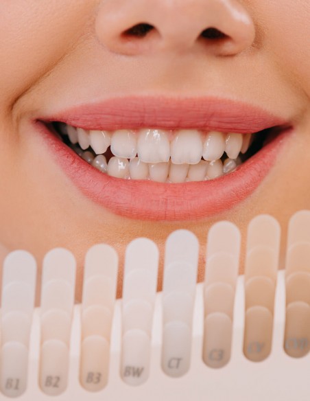 Blanqueamiento dental